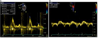 Utility of Cardiovascular Magnetic Resonance-Derived Wave Intensity Analysis As a Marker of Ventricular Function in Children with Heart Failure and Normal Ejection Fraction